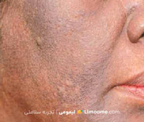 بیماری ماکولار چیست؟